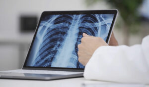 Ein Arzt zeigt auf eine Röntgenaufnahme des Brustkorbs, die auf einem Laptop-Bildschirm angezeigt wird.