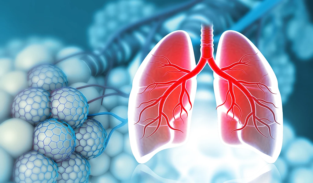 Bronchiektasen – Ursachen, Symptome und Behandlung